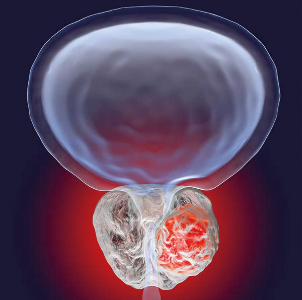 Tratamiento tumor de próstata Dr Jason Zarate