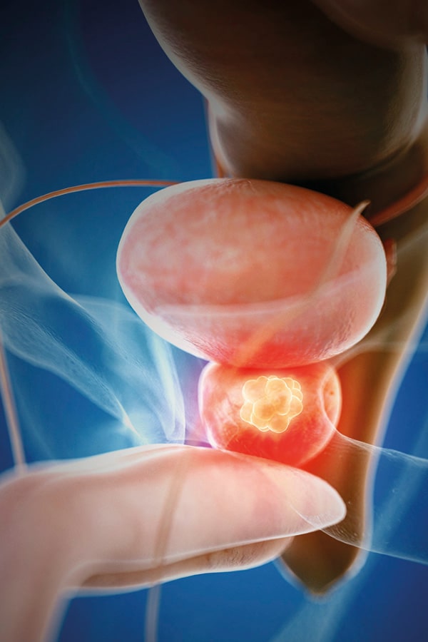 Tratamiento tumor de vejiga Dr Jason Zarate Urólogo