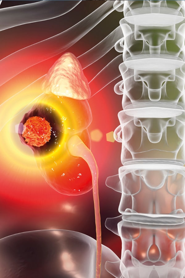 Tratamiento tumor renal Dr Jason Zarate