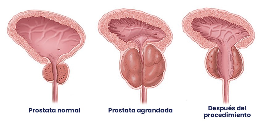 Tratamiento cirugía próstata RTUP Dr Jason Zárate Médico Urólogo